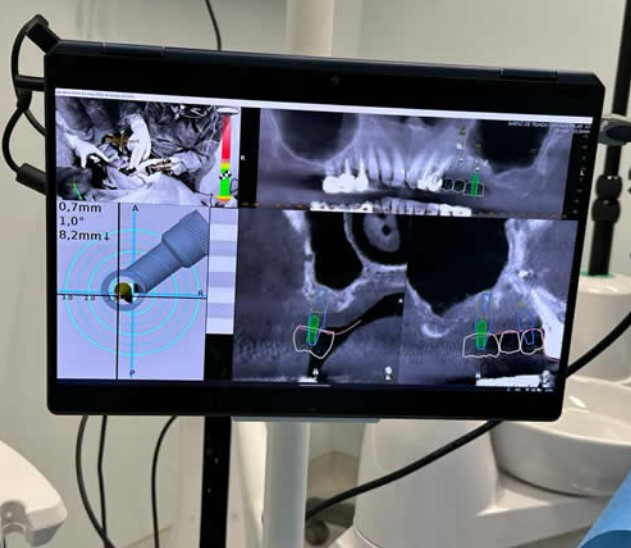 Cirugía Robótica en Odontología